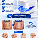 LumiNail Pro™ Tecnología de Fototerapia Láser para el Cuidado de las Uñas